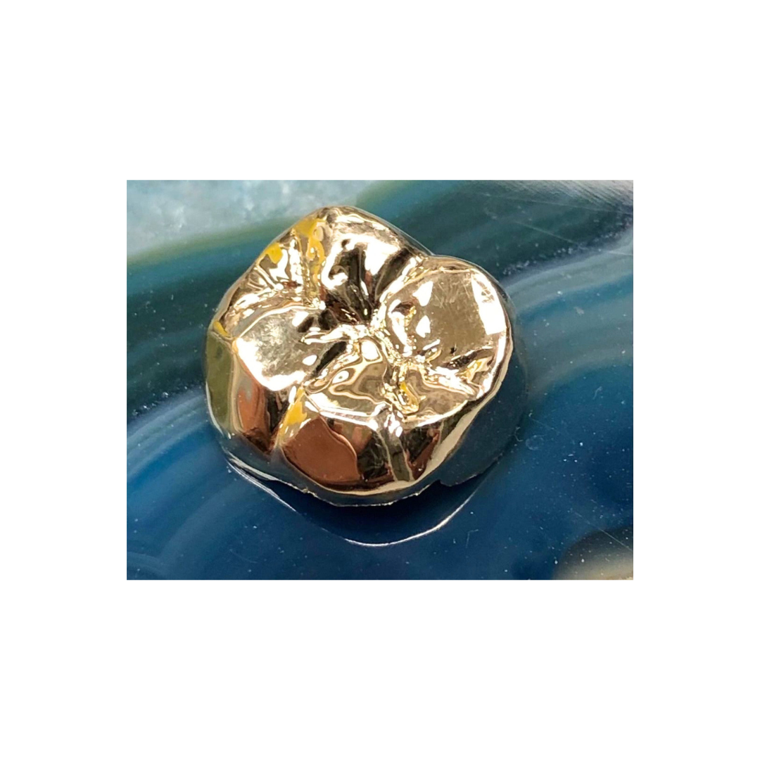 Full metal crown restoration